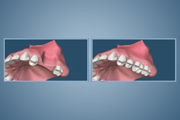 Extraction, Atrophy and Bone Grafting